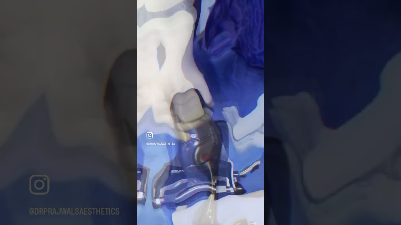 Electric Dermatome for Precise and Faster Skin Graft Harvesting. 