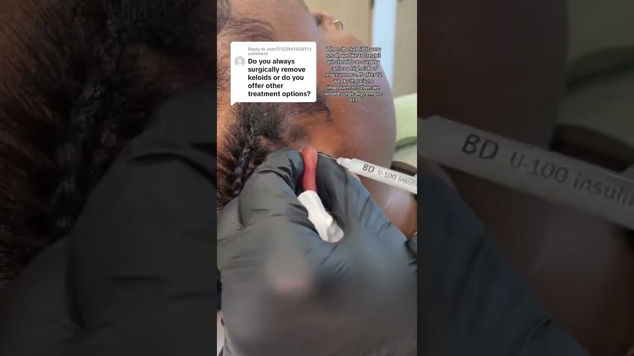 No, we don&rsquo;t always surgically remove keloids #keloid #keloidremoval #keloidinjection