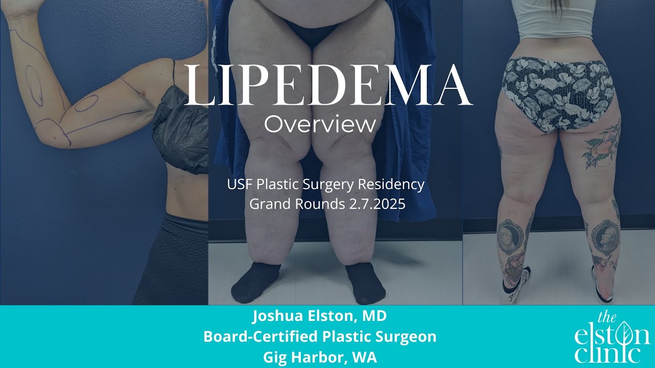 Leading Surgeon Shares Lipedema Expertise