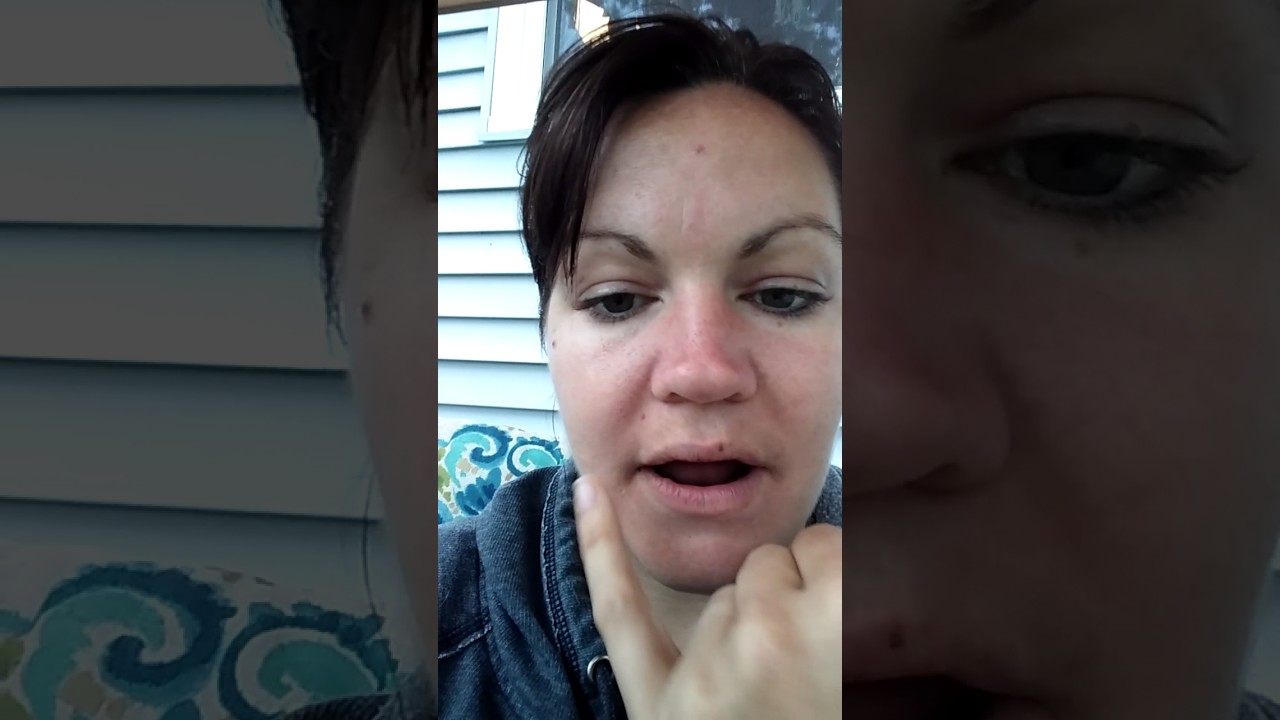 Day one full mouth extractions. NO IMMEDIATE DENTURES