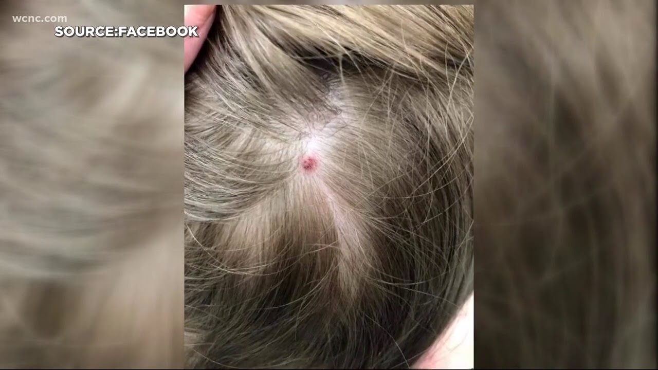Tick bite temporarily paralyzes 5-year-old