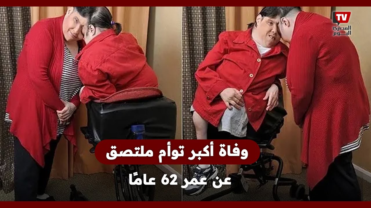 وفــ ــاة أكبر توأم ملتصق عن عمر 62 عامًا