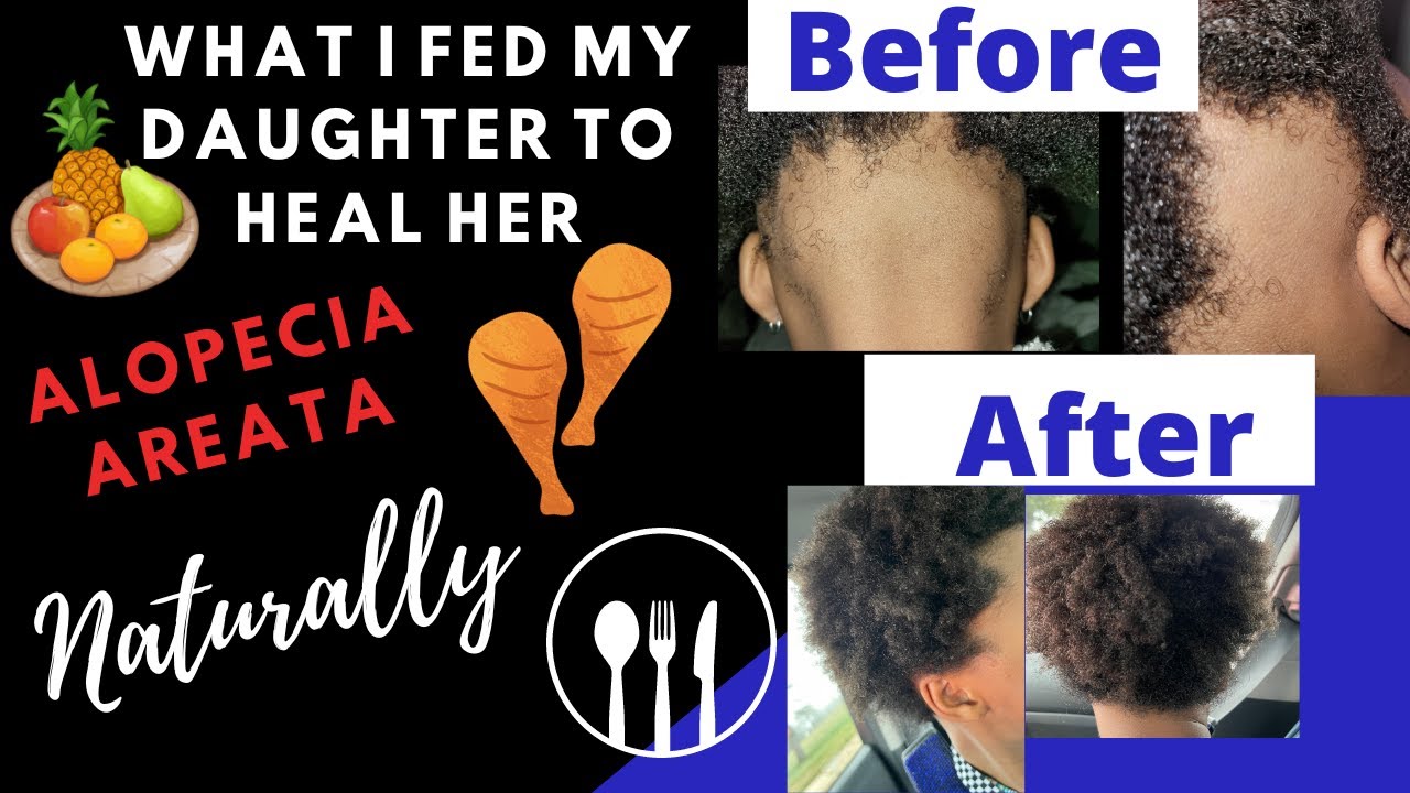 EATING TO HEAL ALOPECIA AREATA |WHAT I FED MY DAUGHTER TO HEAL HER ALOPECIA |WHAT FOODS TO EAT |2025