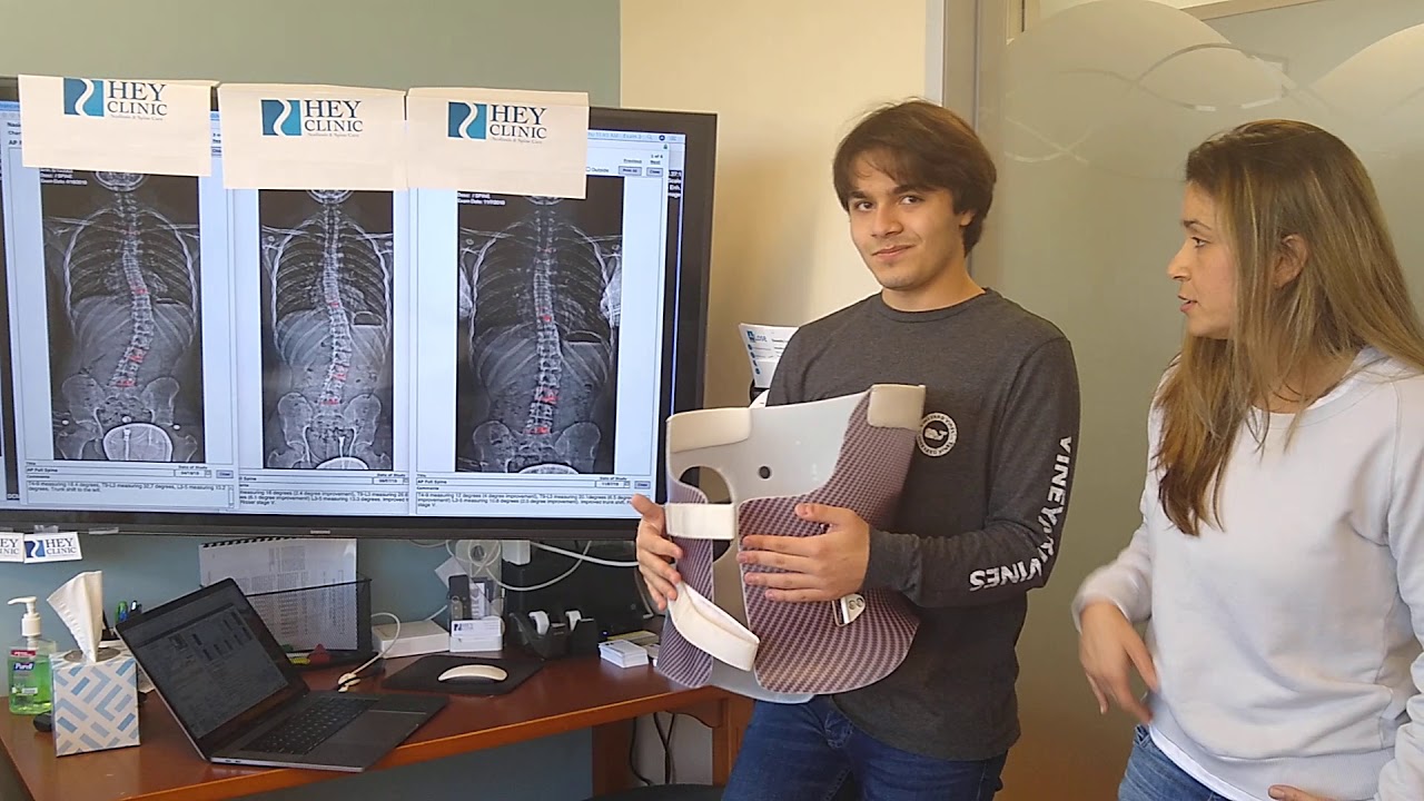 12 degree improvement of adolescent idiopathic scoliosis