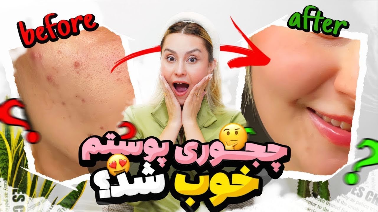با منافذ باز پوستت خداحافظی کن! یه روتین کامل برای پوست صاف