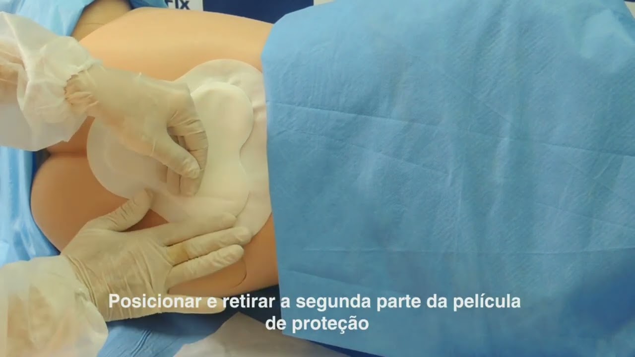 Aplicação Wound Care P - Curativo de Espuma Absorvente Est. com Silicone (Sacral)