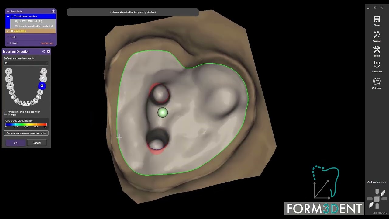 Perno con claventante en una sola ficha de exocad