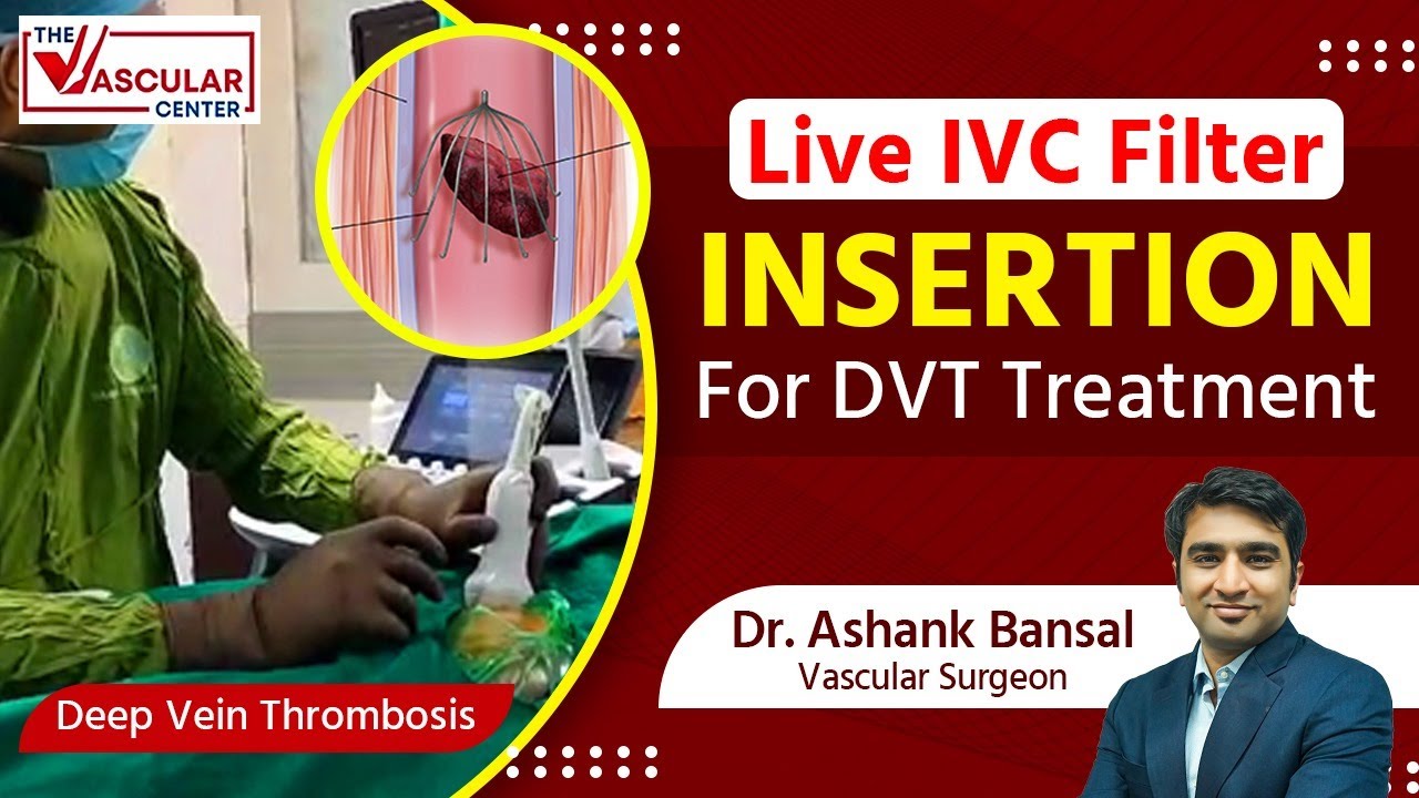 Live Demonstration: IVC Filter Insertion for DVT By Dr. Ashank Bansal