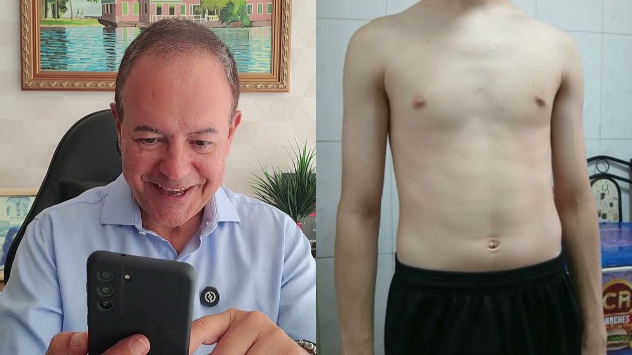 Analisando casos reais de Ginecomastia e Lipomastia #4 [Dr. Jacintho - Cirurgi&atilde;o Pl&aacute;stico]