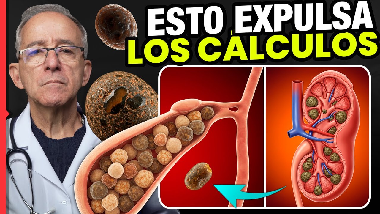 🔴 CALCULOS EN LA VESICULA Y RIÑON: cómo prevenirlos y expulsarlos - Oswaldo Restrepo