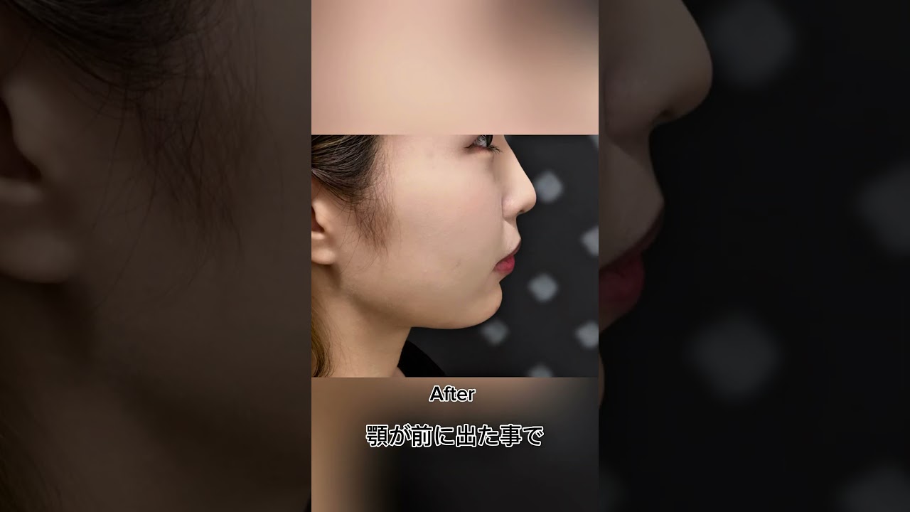 花嫁様におすすめのプチ整形1位　#顎ヒアル　#美容整形 #プチ整形