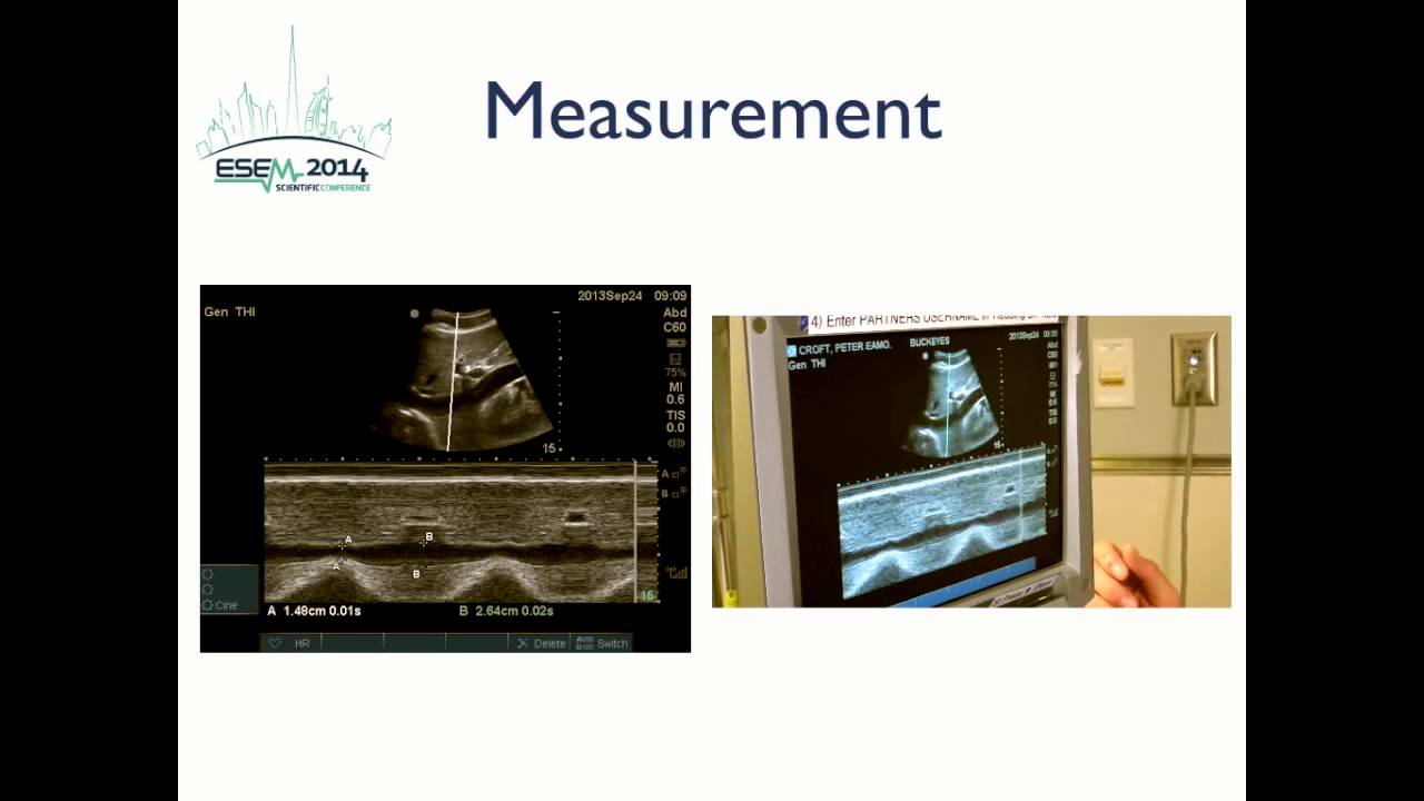 Inferior Vena Cava Ultrasound