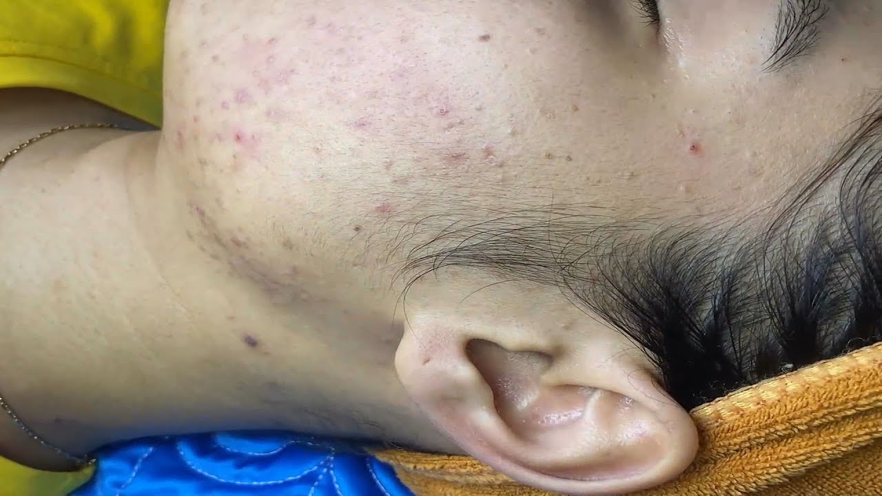 Acne Treament Under The Skin #019