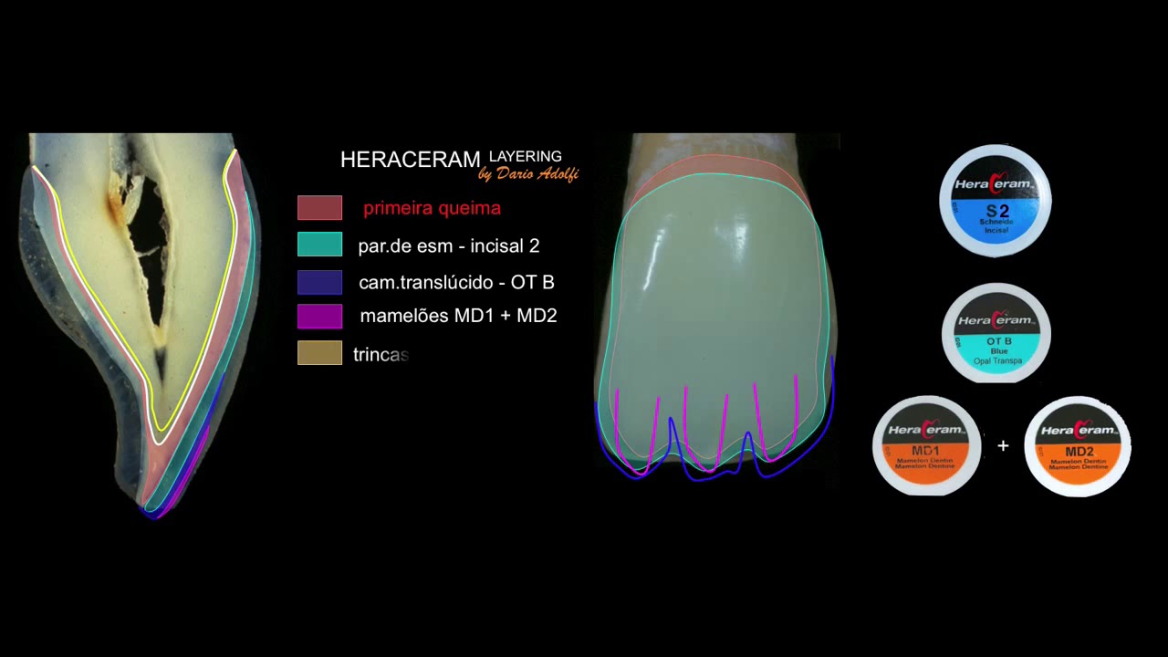 HeraCeram®