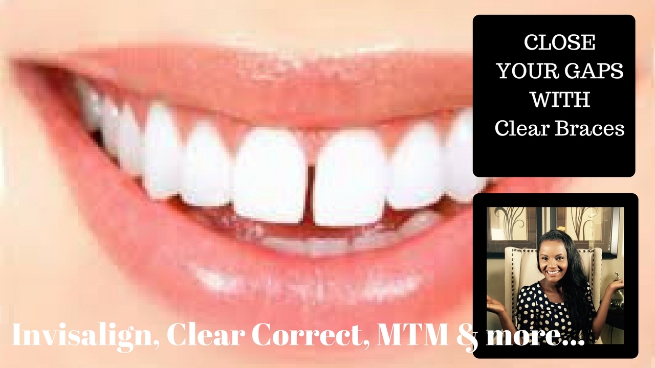 Close your gaps with Clear Correct/ Invisalign
