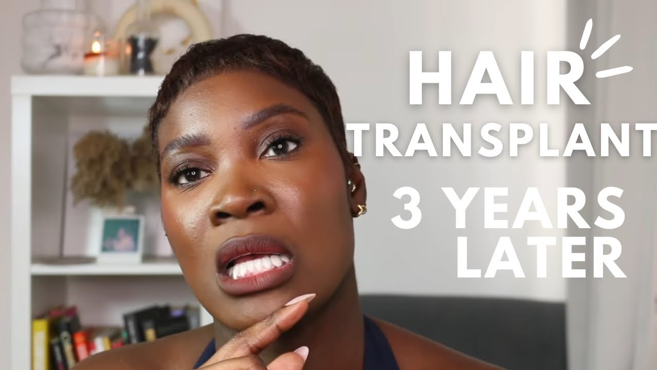 3 Years After My Hair Transplant: The Honest Results