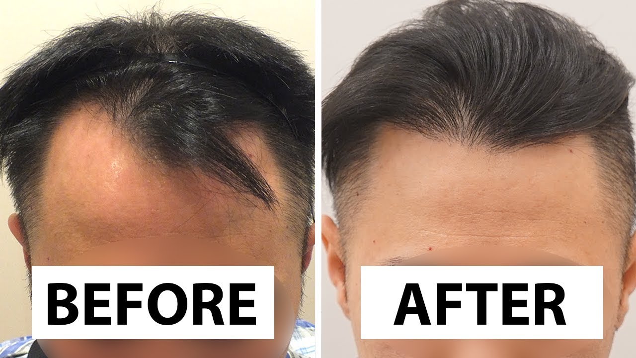 US Patient Asian Type FUE Hair Transplant Before and After Results - Dr. Ali Emre Karadeniz