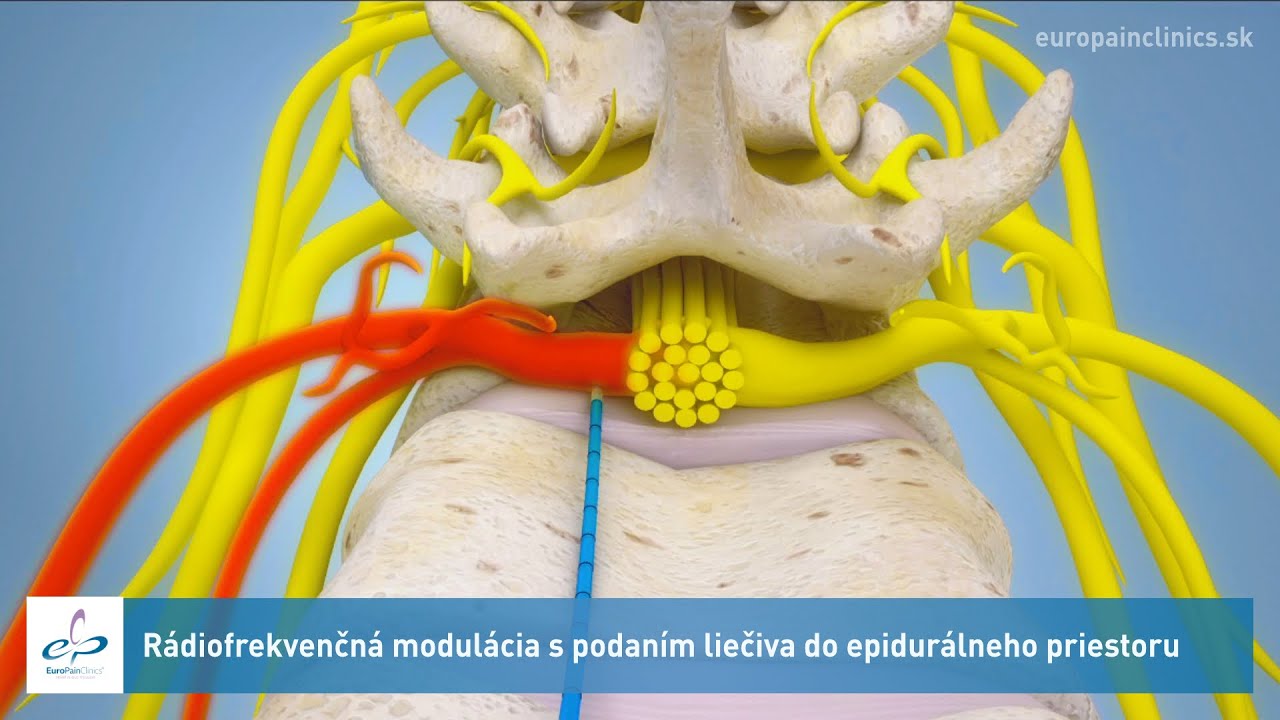 Rádiofrekvenčná modulácia s podaním liečiva do epidurálneho priestoru