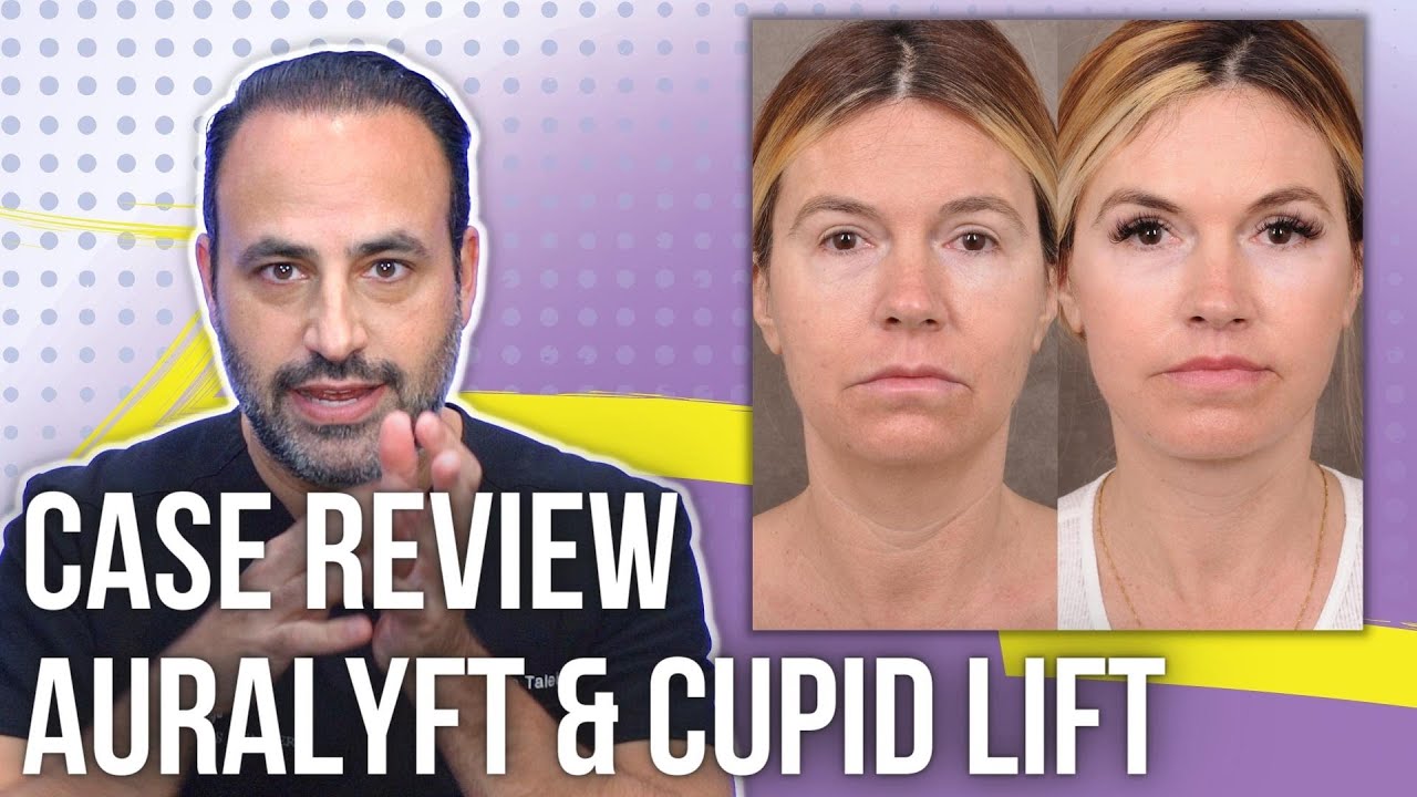 Case Review: Comprehensive AuraLyft & Cupid Lift | Lesson Of The Day
