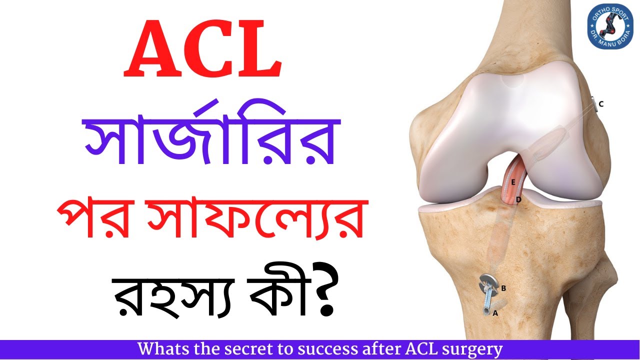 ACL সার্জারির পর সাফল্যের রহস্য কী? Whats the secret to success after ACL surgery
