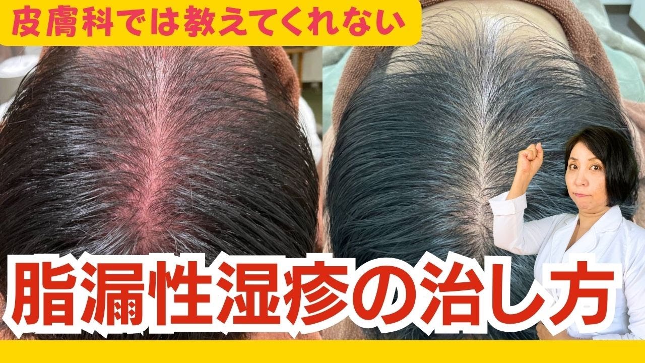 脂漏性皮膚炎の頭皮湿疹、フケや頭の痒み、抜け毛や皮膚科でのステロイド治療で治りにくい原因と今日からできる対策をお伝えします。Aozora