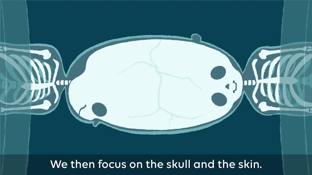 Conjoined twins separation animation
