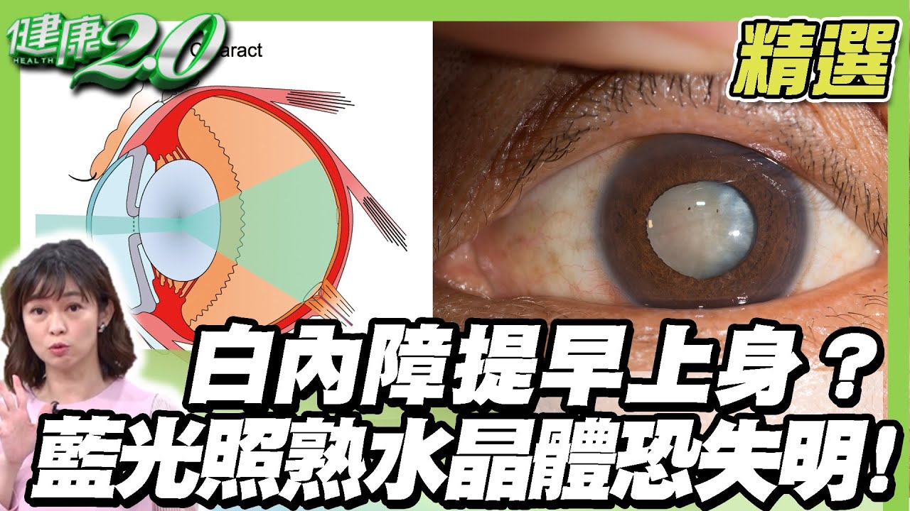 白內障提早上身？藍光照熟水晶體恐失明！眼科專家的護眼處方學起來！健康2.0 (完整版)