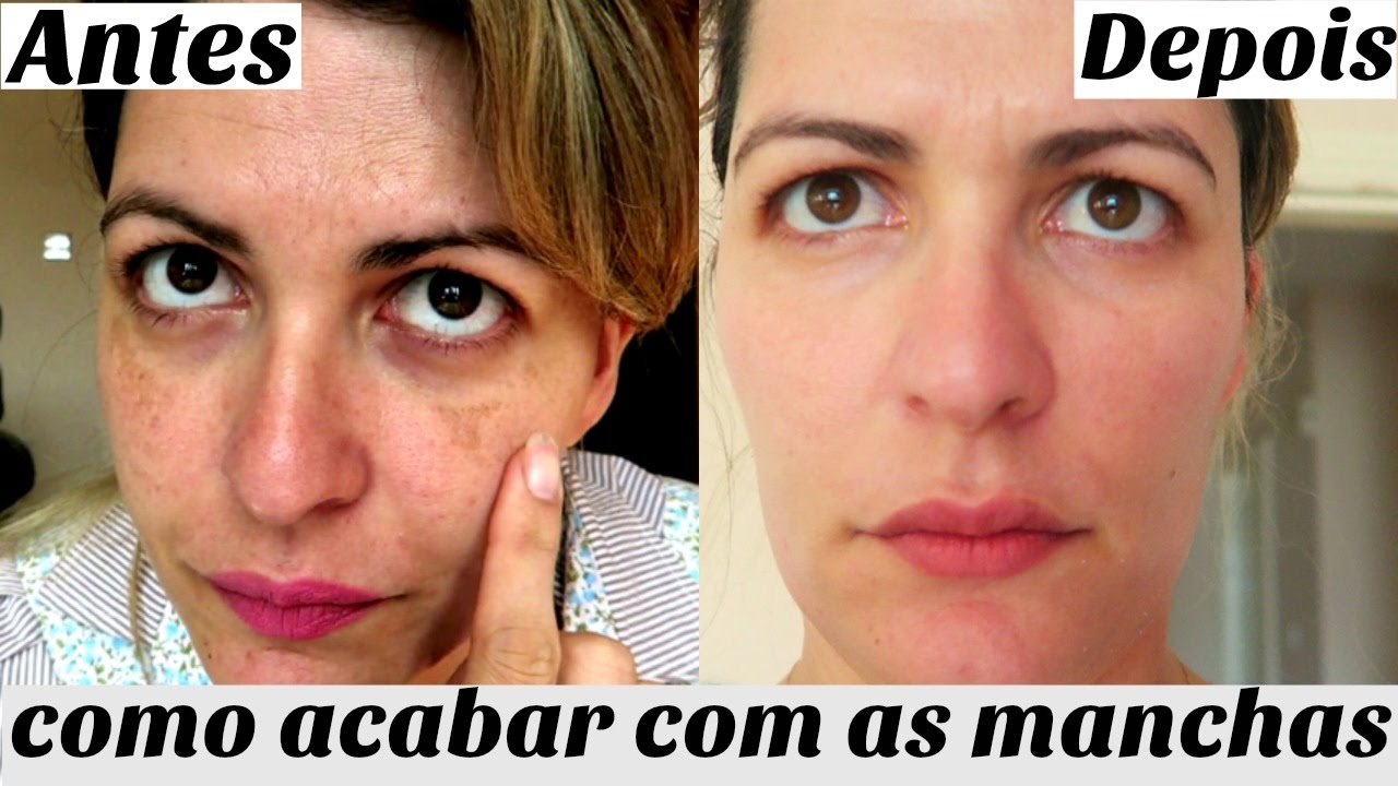 Melasma como clarear com poucos produtos!