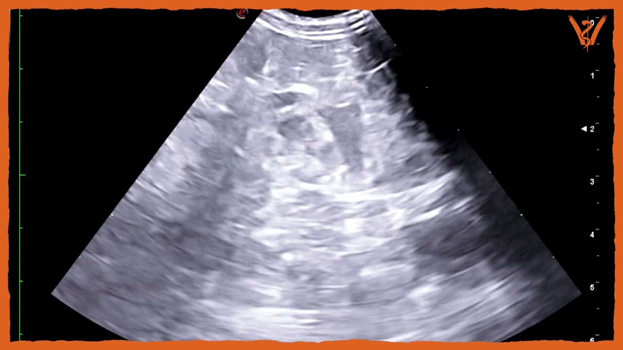 Ultraschall Artefakte Harnblase Uterus Prostata