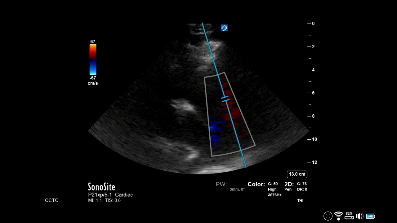 How to...Measure Pulmonary Acceleration Time