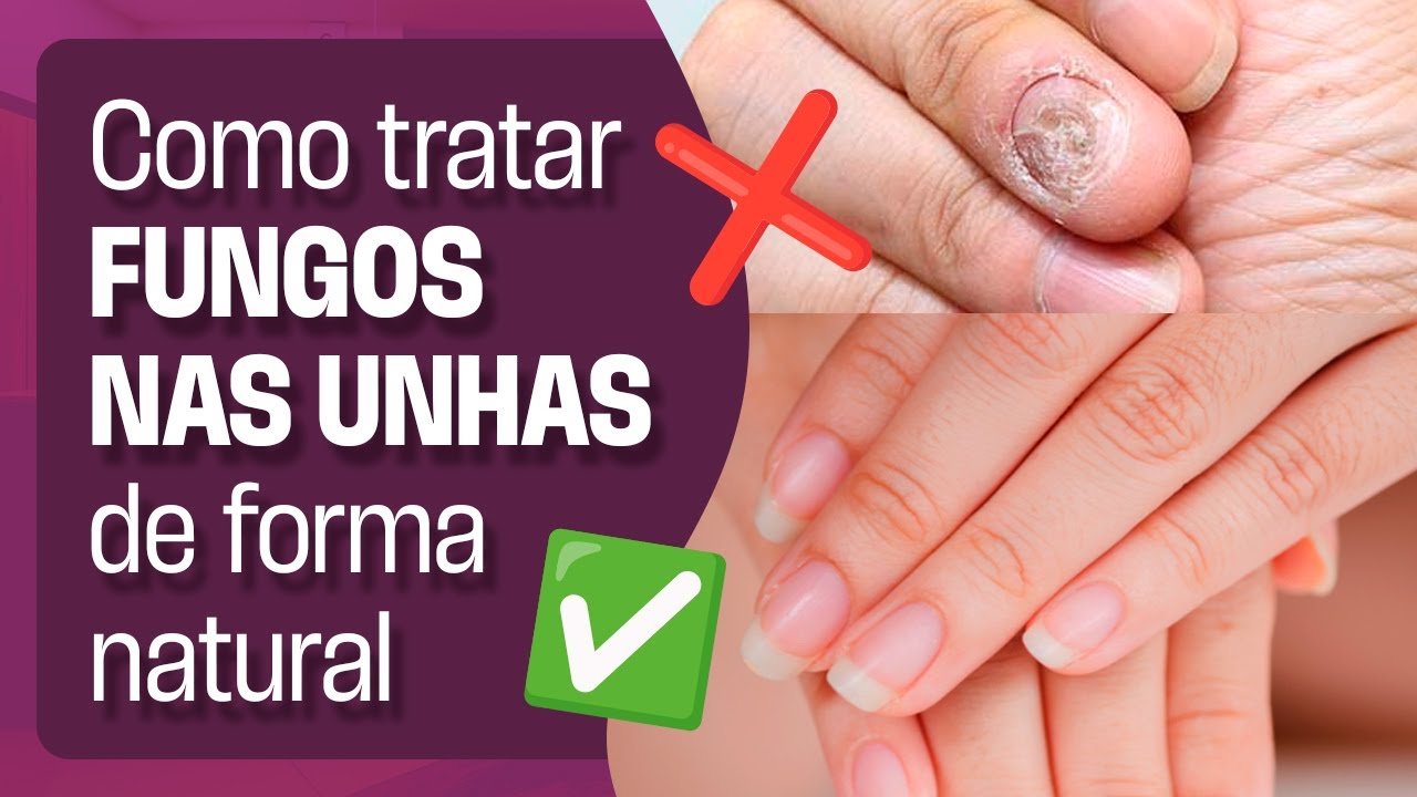 Como tratar FUNGOS NAS UNHAS de forma natural | Portal APS Beleza