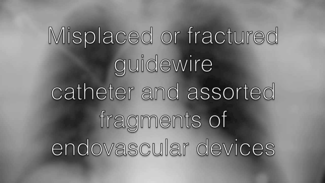 Retrieval of intravascular foreign body