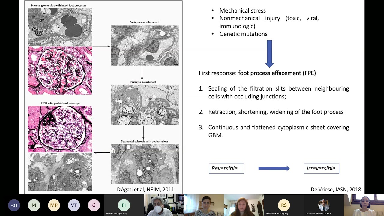 Glomerulosclerosi Focale Segmentale (GSFS): il ruolo dei test genetici nel processo diagnostico