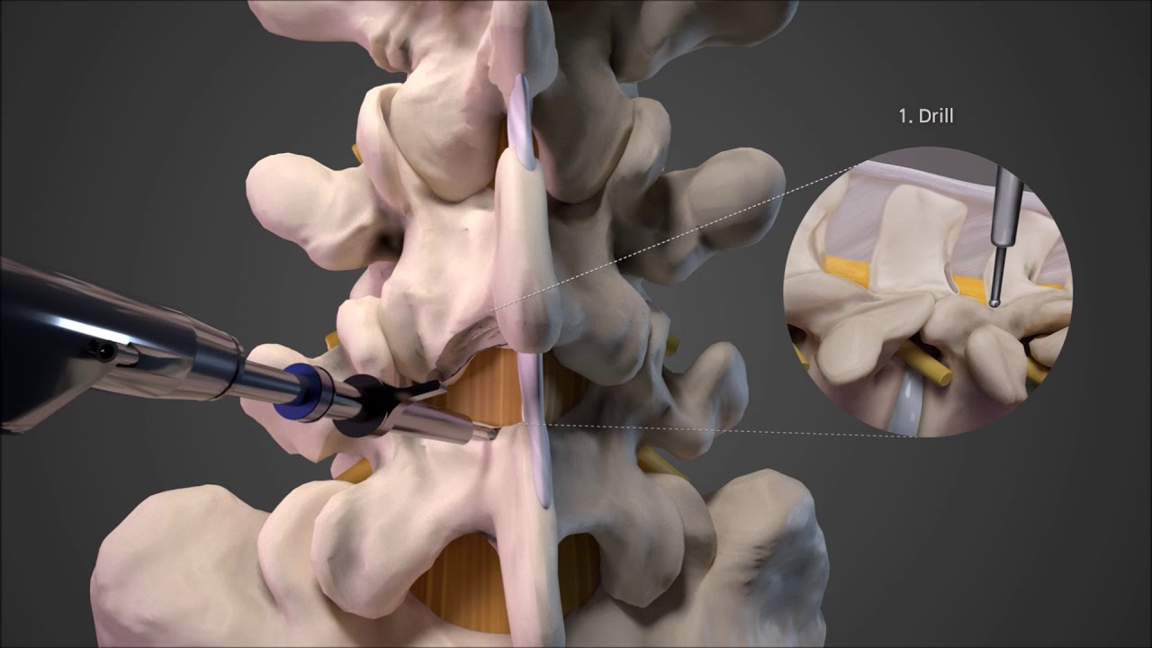 Full Endoscopic Stenosis Lumbar Decompression