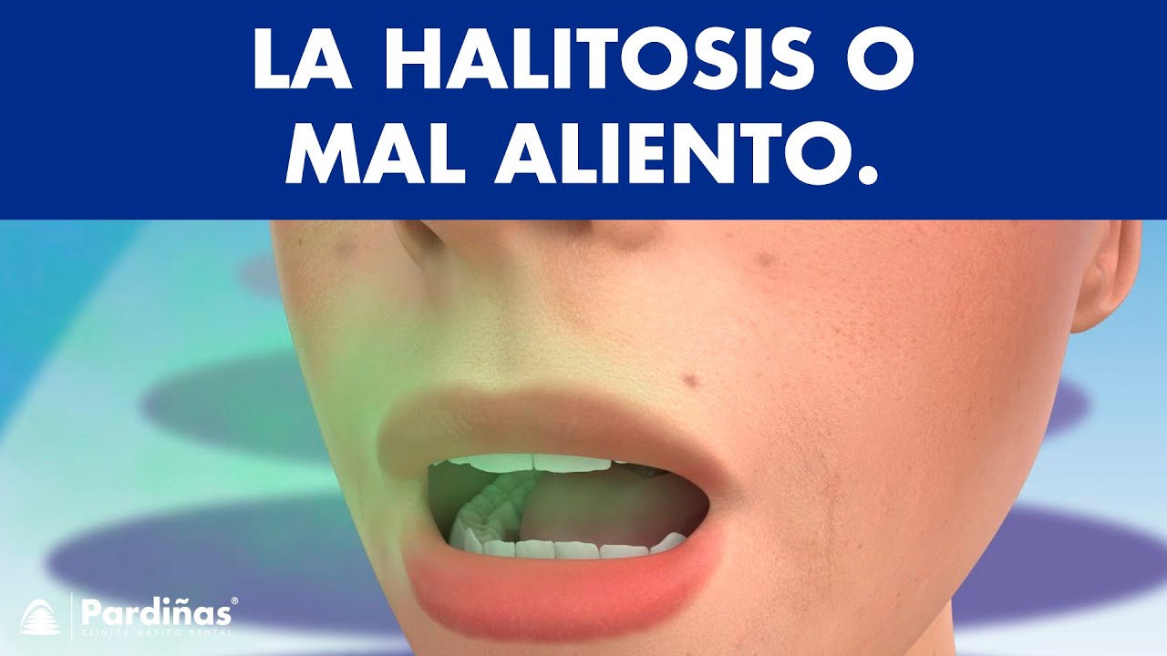 Mal aliento o Halitosis - ¿Qué la causa y cómo se cura? ©