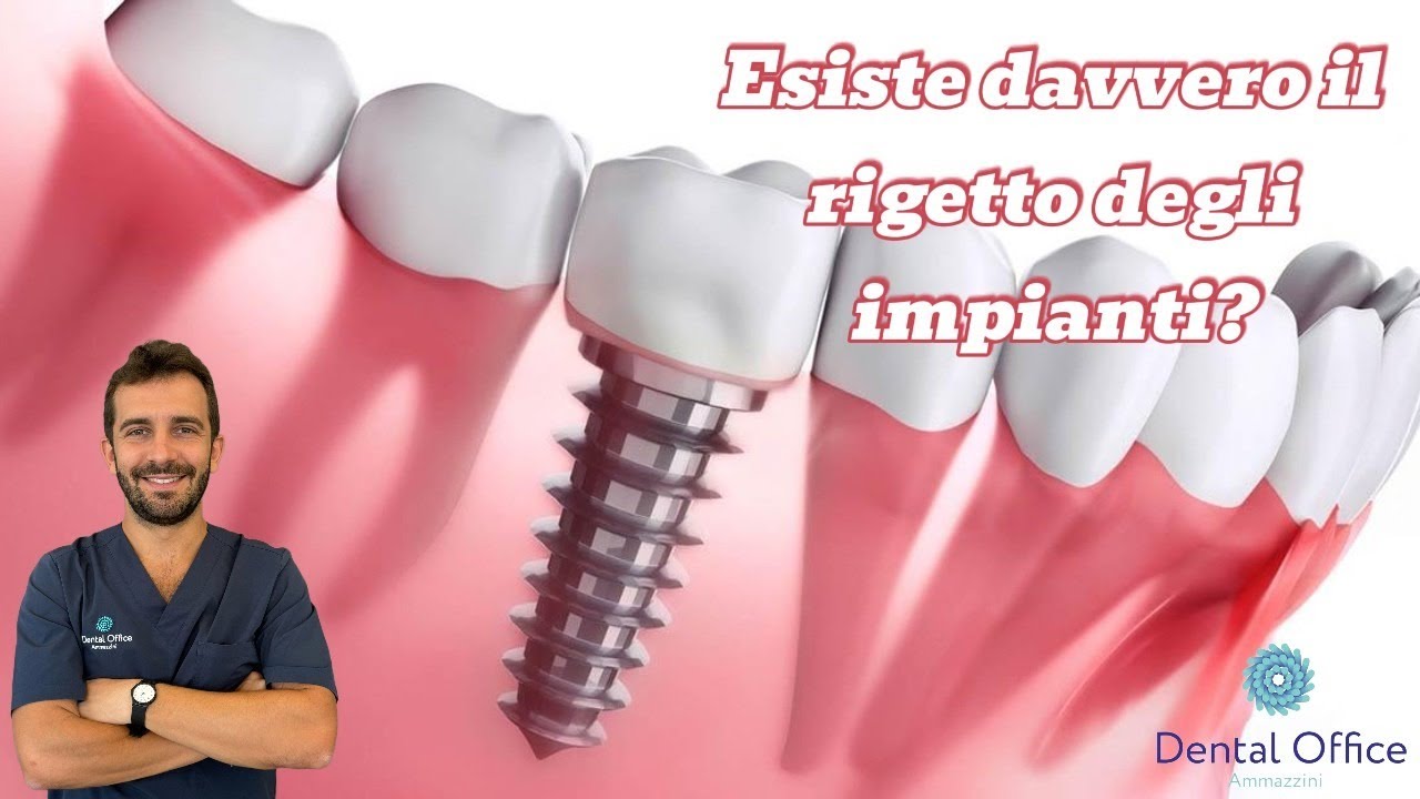 Il RIGETTO degli IMPIANTI DENTALI NON ESISTE! Ecco la verità che nessuno ti ha mai detto
