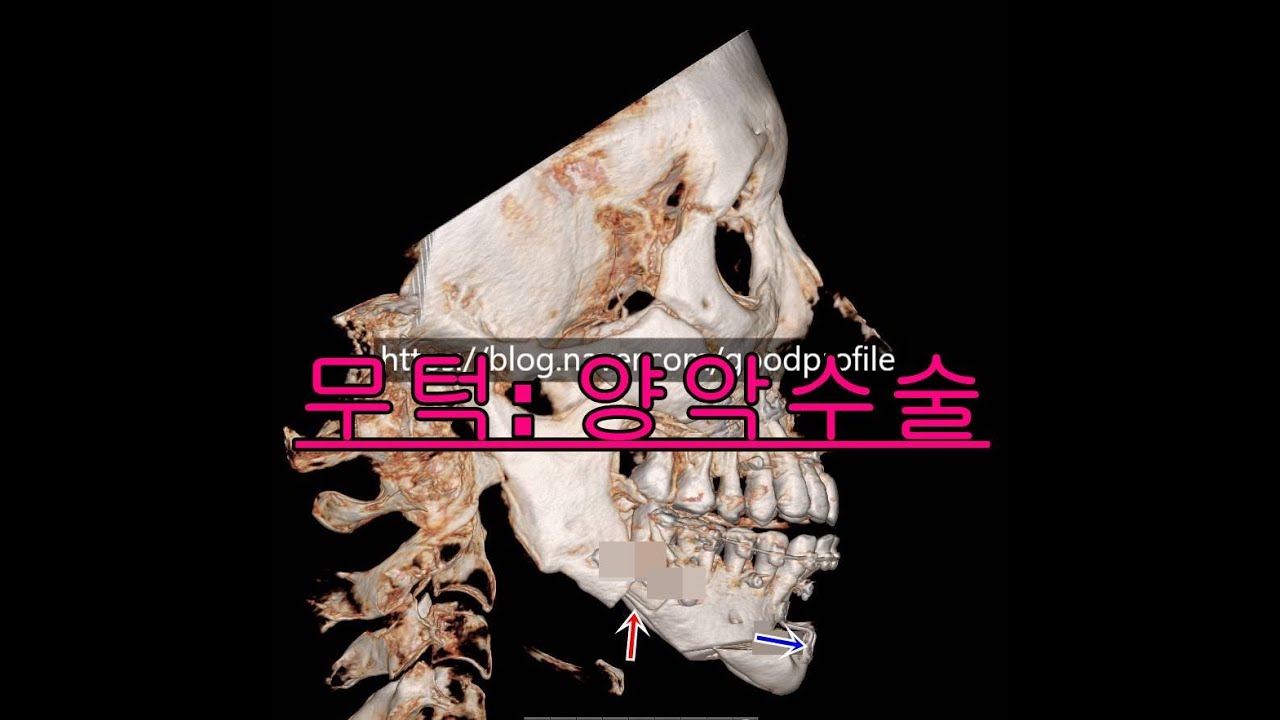 [CBK성형외과_최봉균원장] 무턱교정 시리즈 4 - 안면비대칭 부정교합동반 무턱수술은 양악수술[CBK整形外科] 無顎矯正シリーズ4 - 顔面非対称、不正咬合時の顎無し手術は両側手術