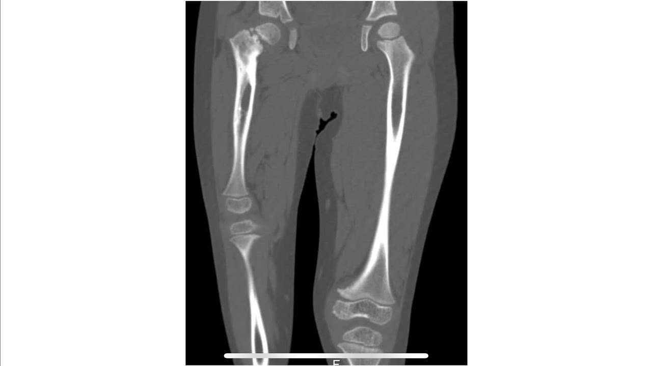 Proximal femoral focal deficiency (PFFD)