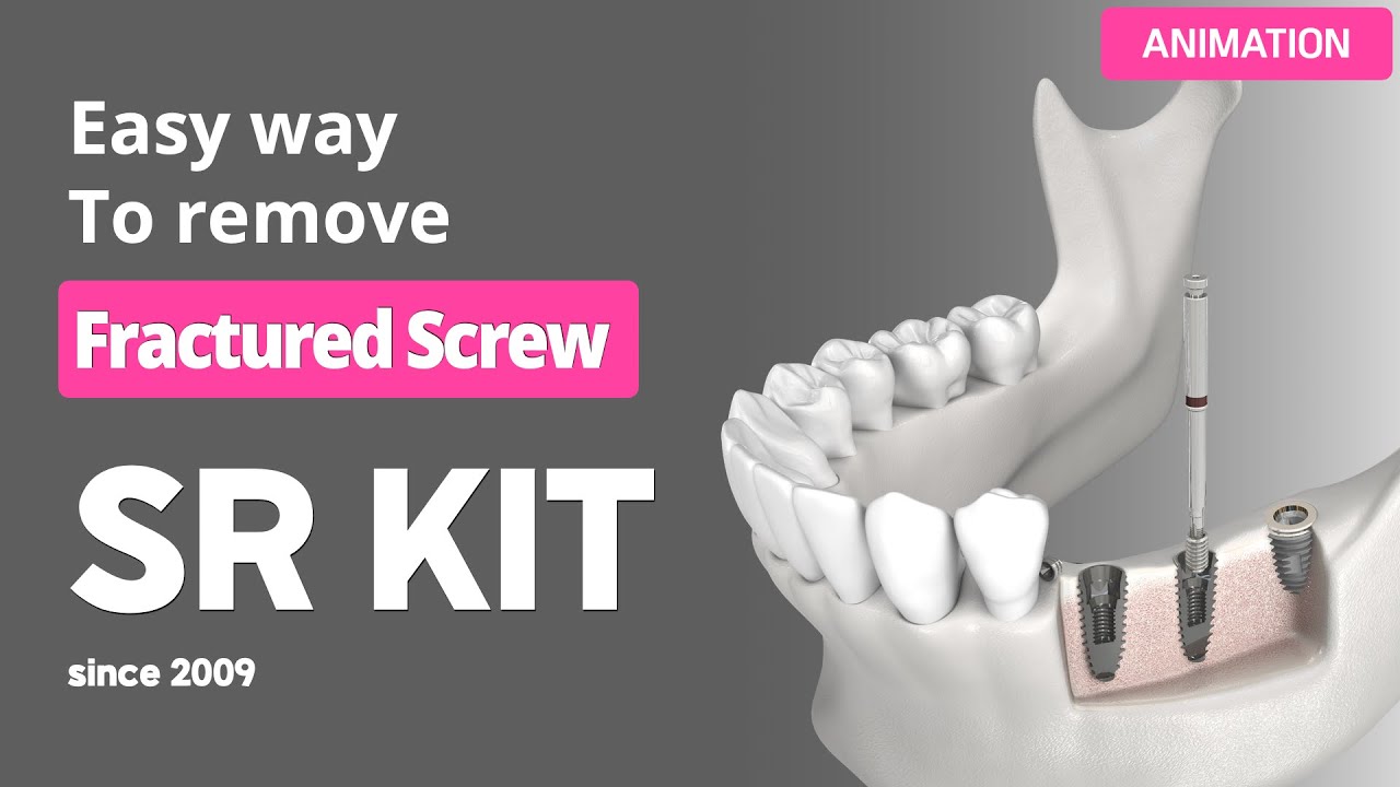Easy way to remove fractured screw - Screw Remover Kit (SR kit)