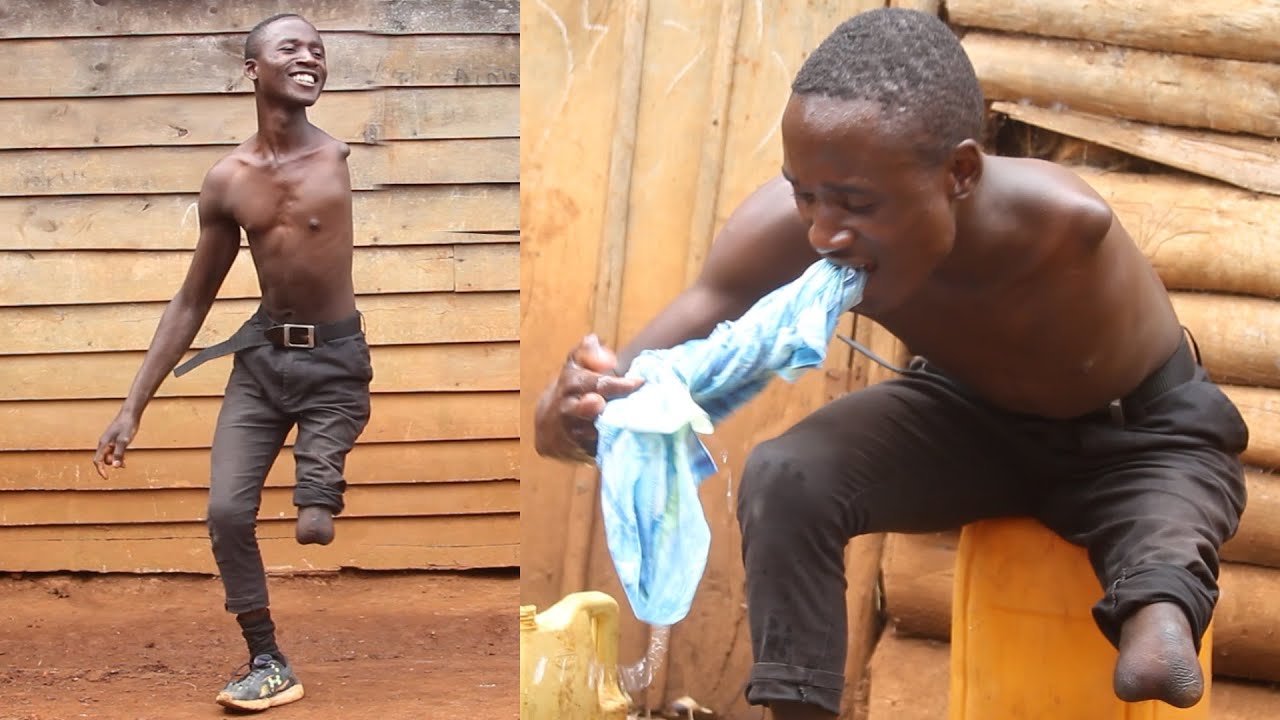 Living Without Limbs : BORN DIFFERENT