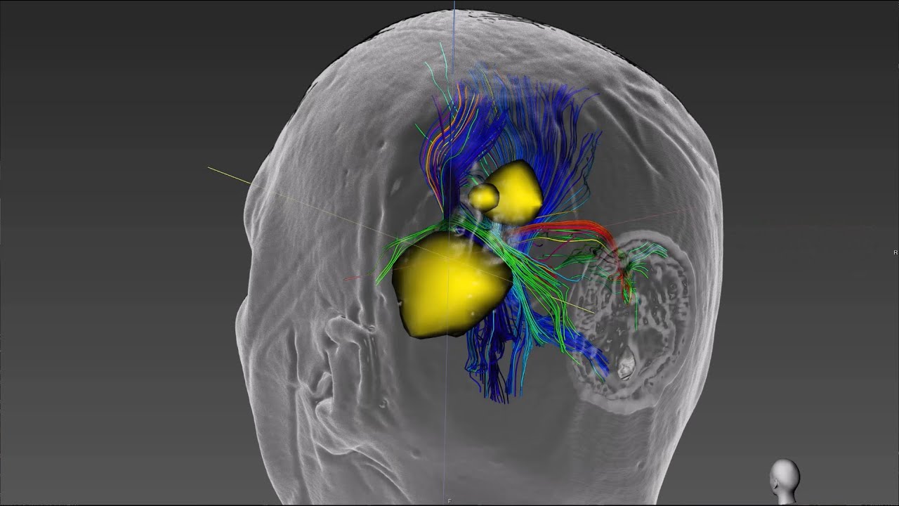 Introducing Tractography in Navient: Advanced Brain Pathway Mapping