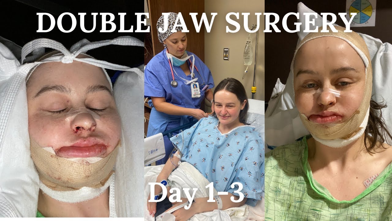Day 1-3 | Double Jaw Surgery Journey
