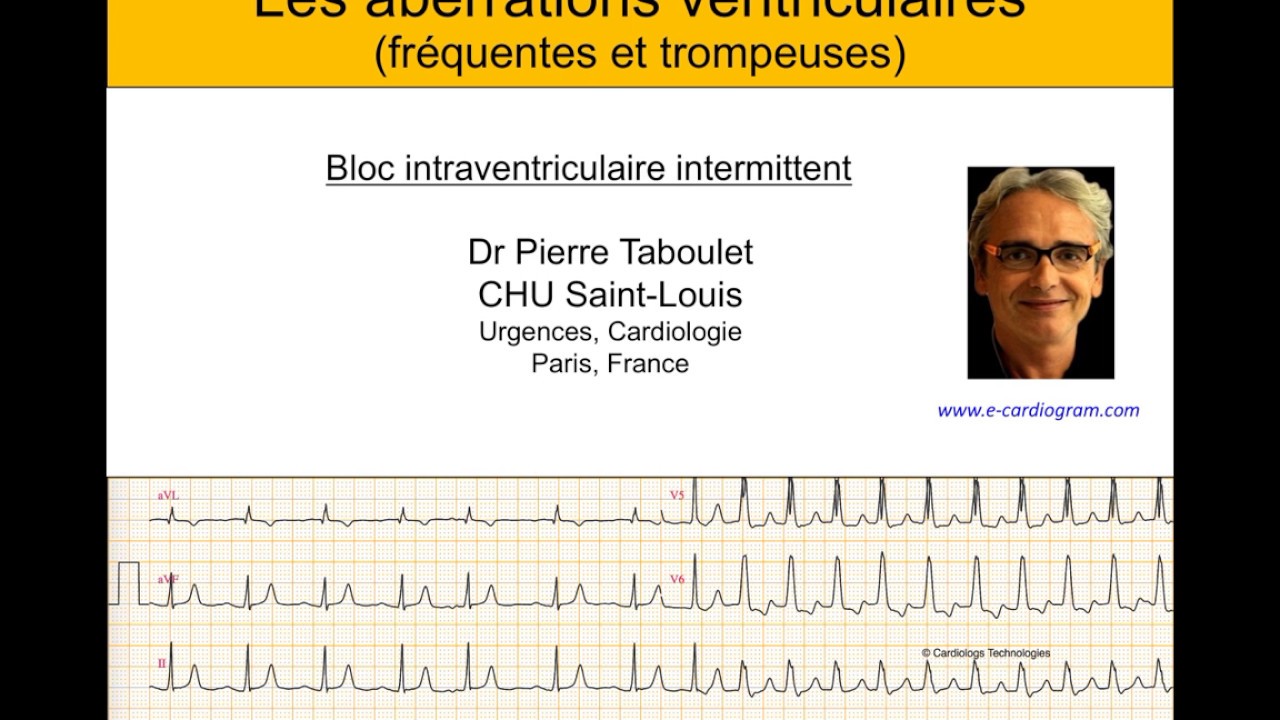4h. Aberration ventriculaire (bloc de branche) ou ESV ? ECG Dr Taboulet