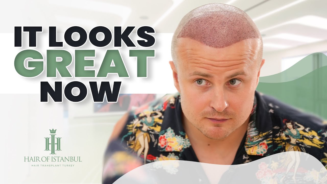 David's Journey: Hair Transplant from UK to Istanbul
