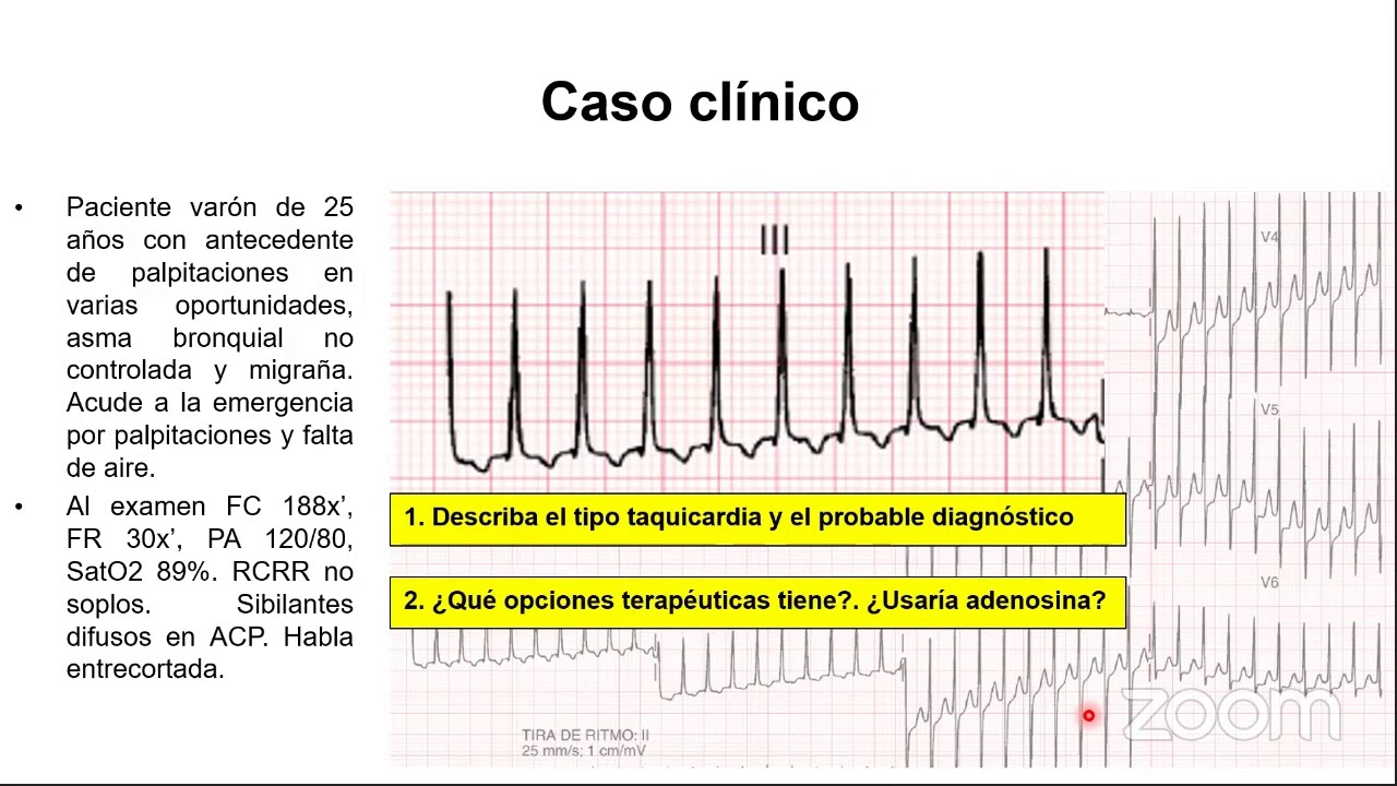 EKG - Arritmias Supra ventriculares | Dr. Bank