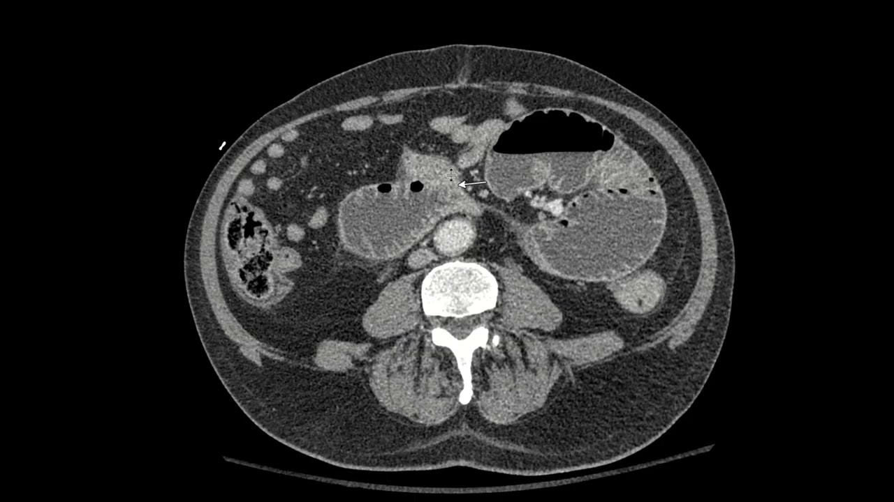 Closed loop small bowel obstruction on CT