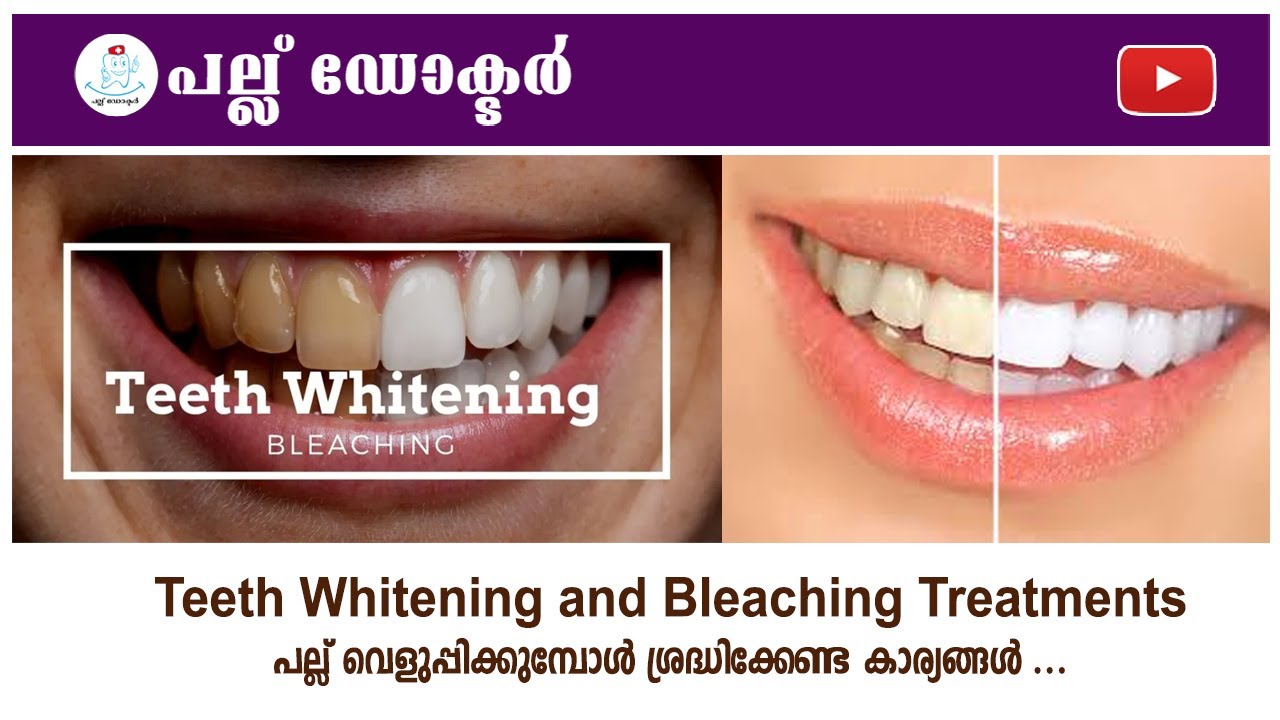 പല്ല് വെളുപ്പിക്കുമ്പോൾ ശ്രദ്ധിക്കേണ്ട കാര്യങ്ങൾ ... / Teeth Whitening & Bleaching Treatments