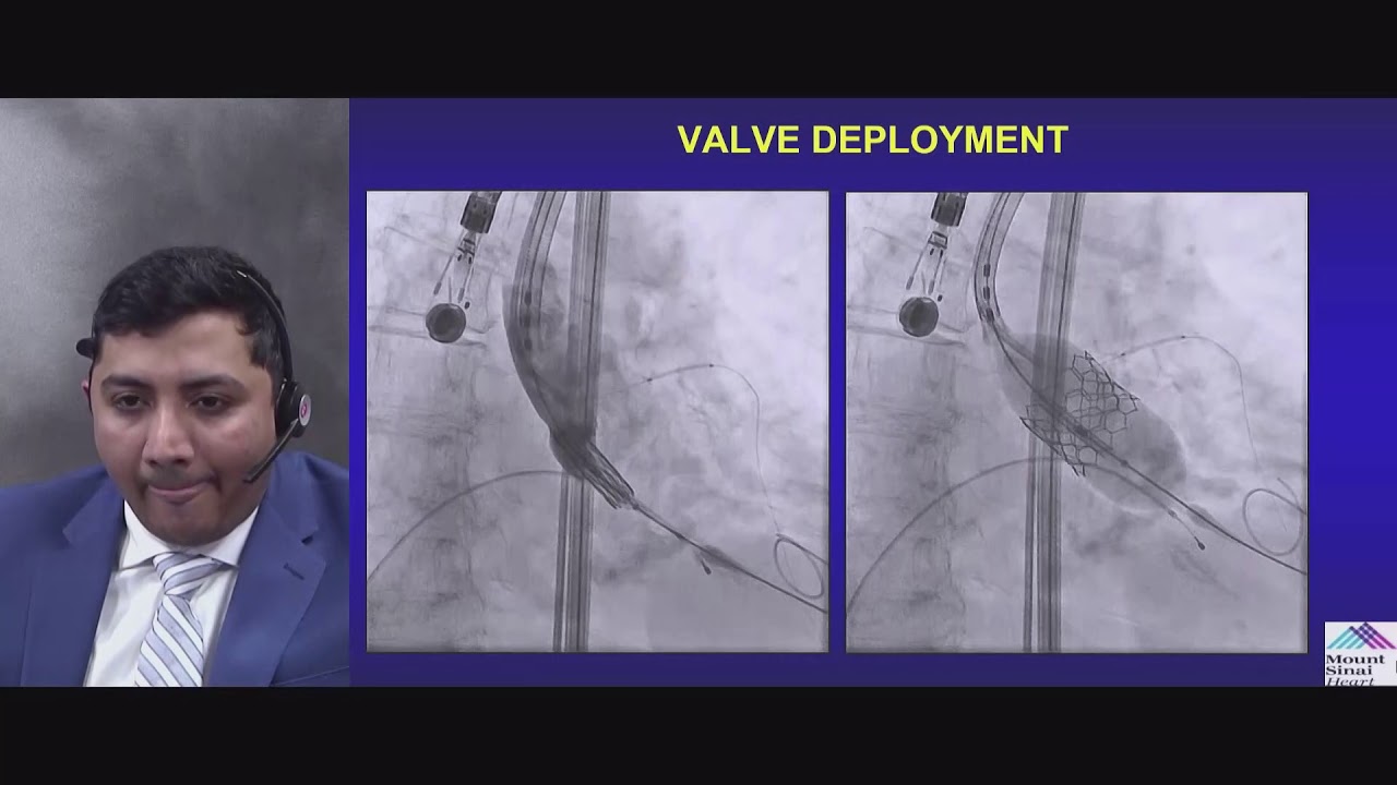 BEST CASE PRESENTATIONS BY STRUCTURAL HEART FELLOWS 1 2
