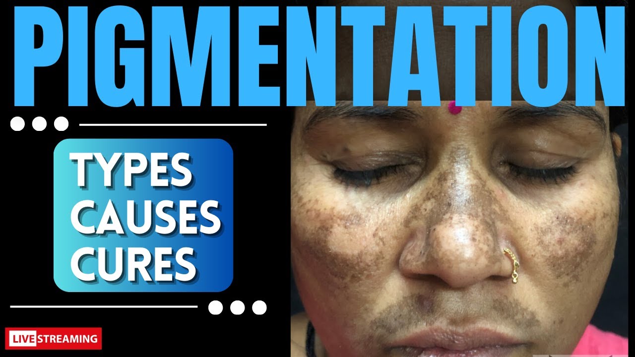 PIGMENTATION: Types, Causes & Cures. Sunday Live #83