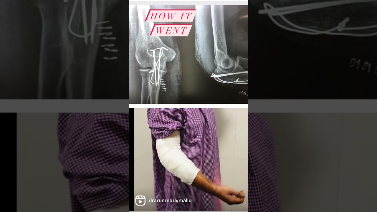 Elbow fracture - olecranon fracture. #orthopaedicprinciples #hitechcity #tuesdaymotivation #love